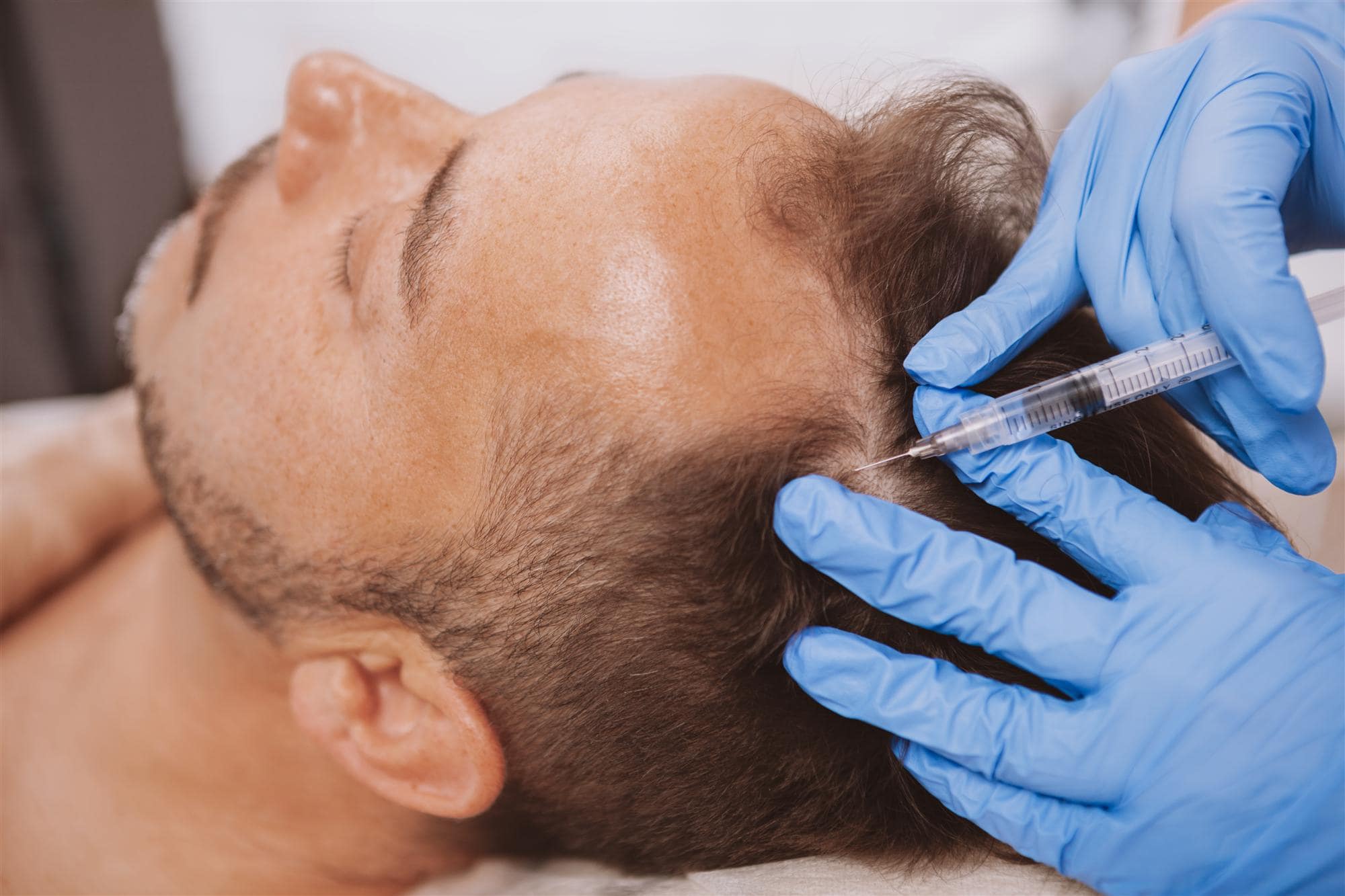 An Overview of Effective Hair Loss Treatments